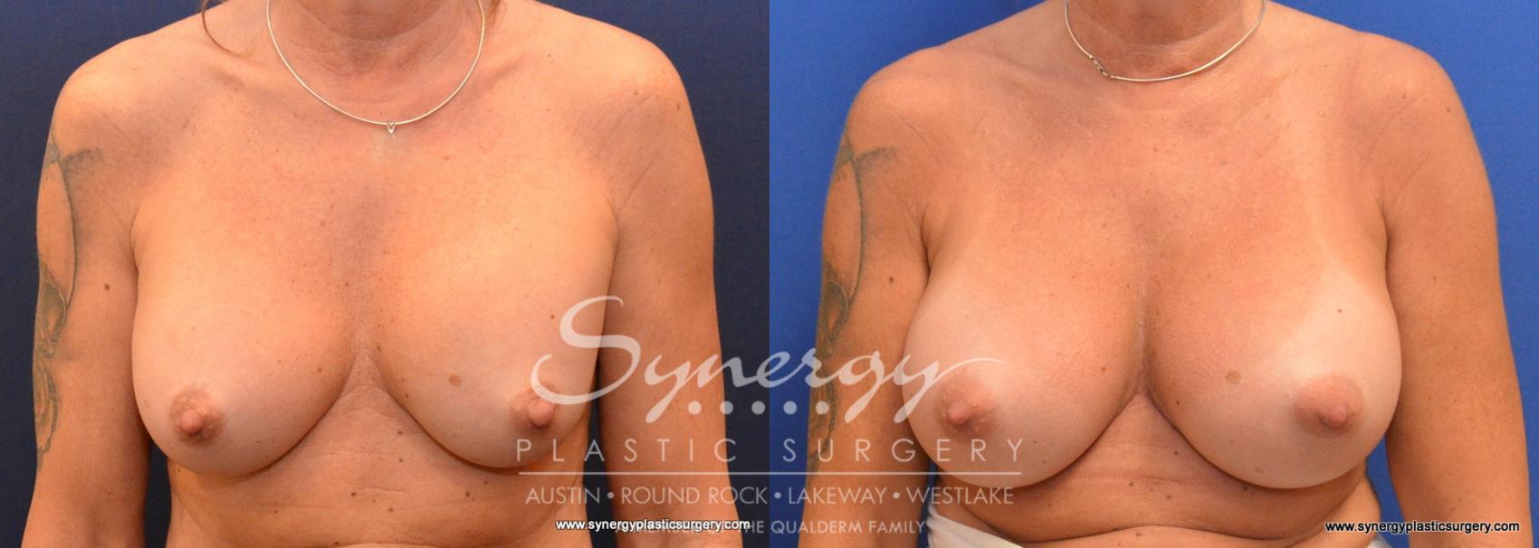 Before & After Revision Breast Augmentation Case 592 View #1 View in Austin, TX