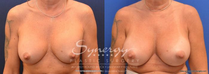 Before & After Revision Breast Augmentation Case 592 View #1 View in Austin, TX