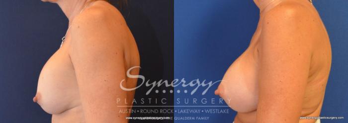 Before & After Revision Breast Augmentation Case 592 View #2 View in Austin, TX