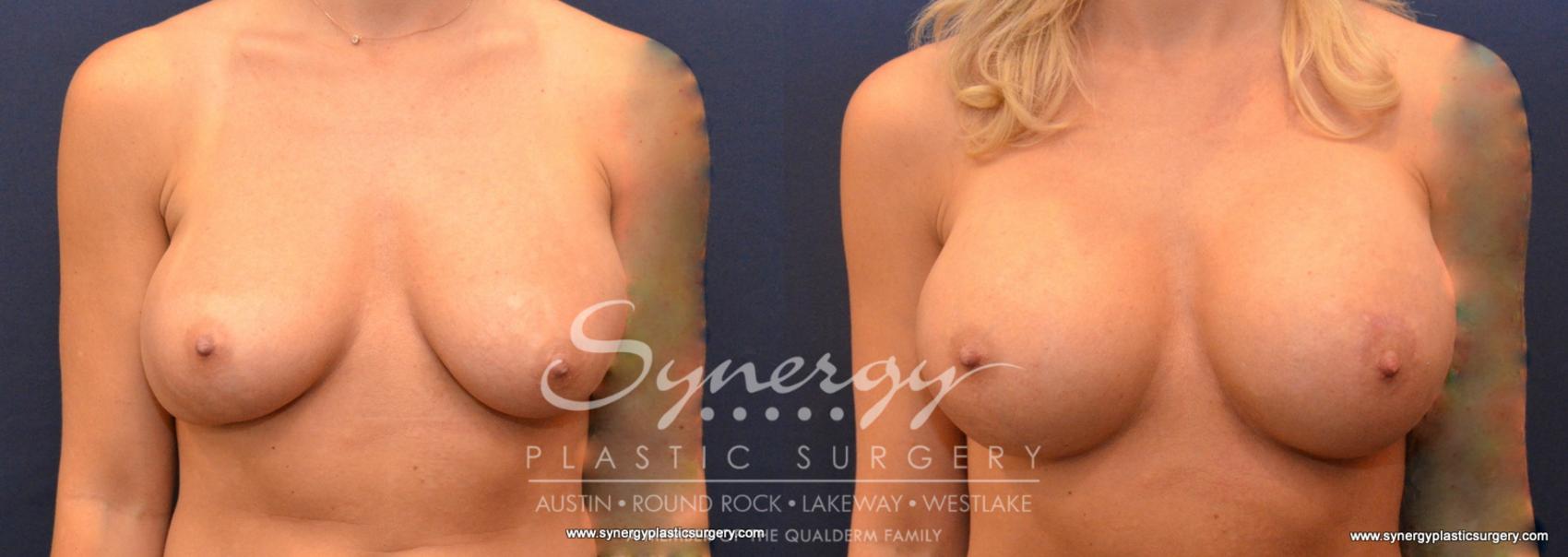 Before & After Revision Breast Augmentation Case 610 View #1 View in Austin, TX