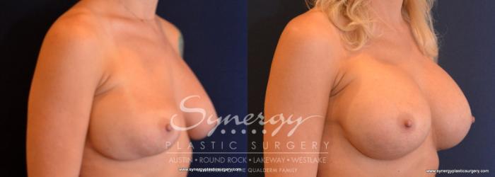 Before & After Revision Breast Augmentation Case 610 View #3 View in Austin, TX