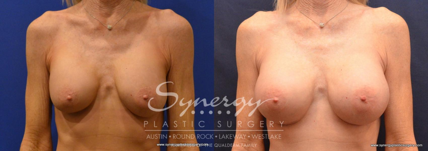Before & After Revision Breast Augmentation Case 644 View #1 View in Austin, TX