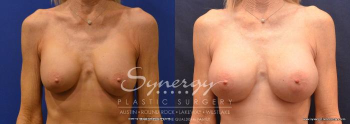 Before & After Revision Breast Augmentation Case 644 View #1 View in Austin, TX