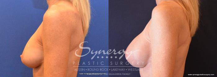 Before & After Revision Breast Augmentation Case 644 View #3 View in Austin, TX