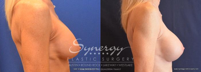Before & After Revision Breast Augmentation Case 644 View #5 View in Austin, TX