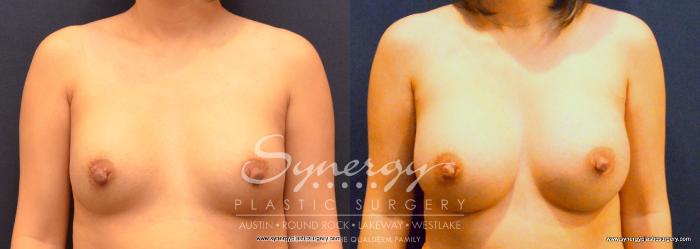 Before & After Revision Breast Augmentation Case 673 View #1 View in Austin, TX