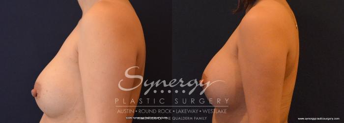 Before & After Revision Breast Augmentation Case 673 View #2 View in Austin, TX