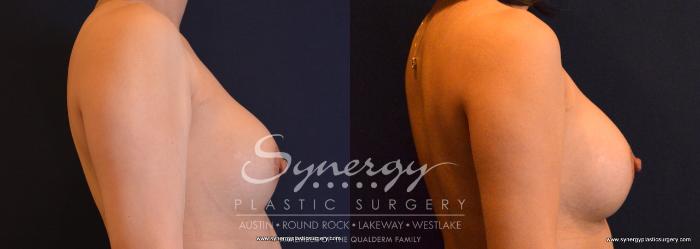 Before & After Revision Breast Augmentation Case 673 View #3 View in Austin, TX