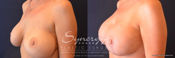 Before & After Revision Breast Augmentation Case 679 View #2 View in Austin, TX
