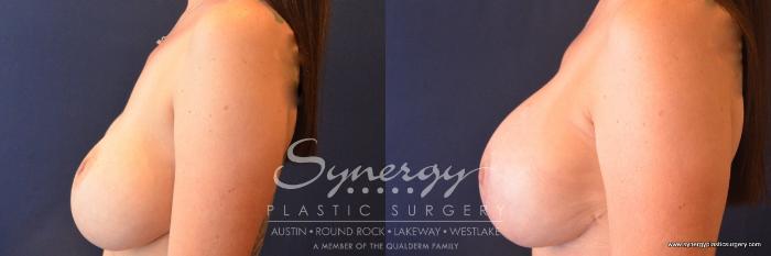 Before & After Revision Breast Augmentation Case 679 View #3 View in Austin, TX