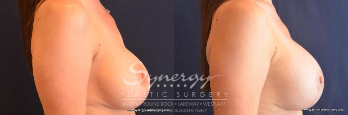 Before & After Revision Breast Augmentation Case 679 View #4 View in Austin, TX