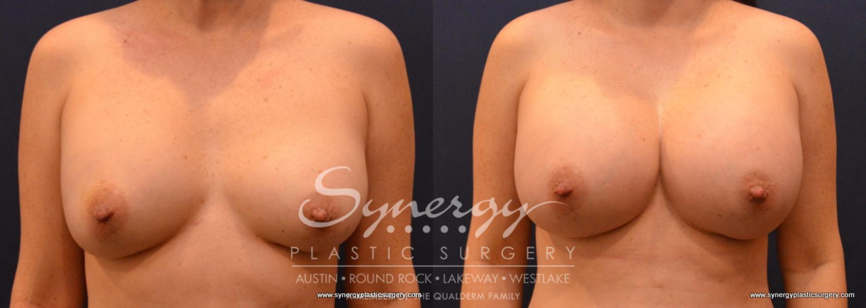 Before & After Revision Breast Augmentation Case 693 View #1 View in Austin, TX