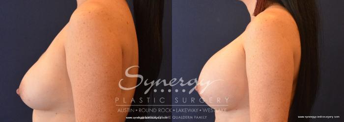 Before & After Revision Breast Augmentation Case 693 View #3 View in Austin, TX