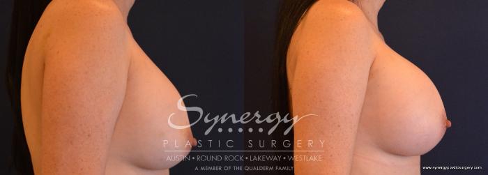 Before & After Revision Breast Augmentation Case 693 View #4 View in Austin, TX