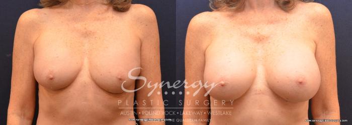 Before & After Revision Breast Augmentation Case 709 View #1 View in Austin, TX