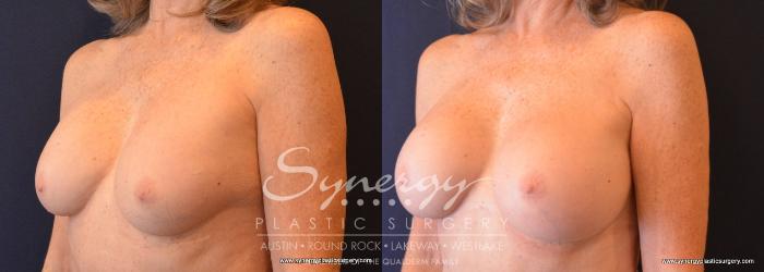 Before & After Revision Breast Augmentation Case 709 View #2 View in Austin, TX