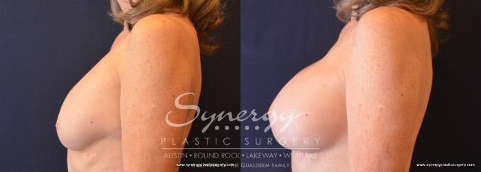 Before & After Revision Breast Augmentation Case 709 View #3 View in Austin, TX