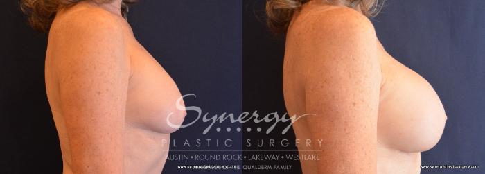 Before & After Revision Breast Augmentation Case 709 View #5 View in Austin, TX