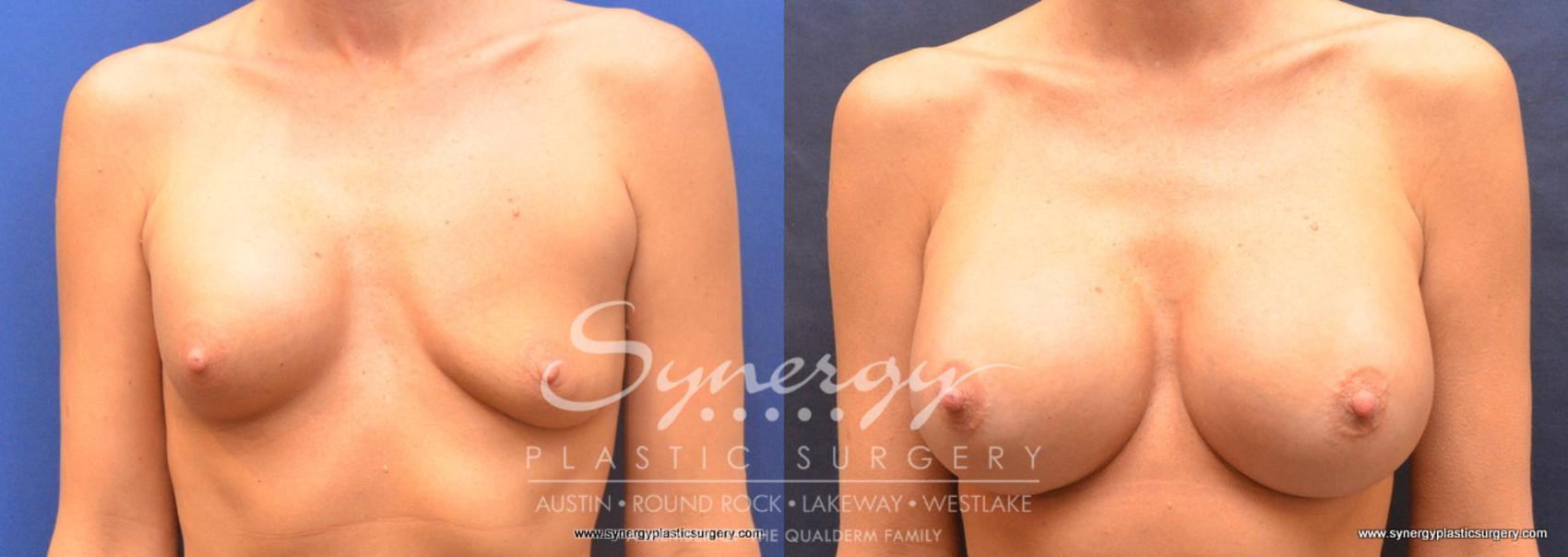 Before & After Revision Breast Augmentation Case 758 View #1 View in Austin, TX