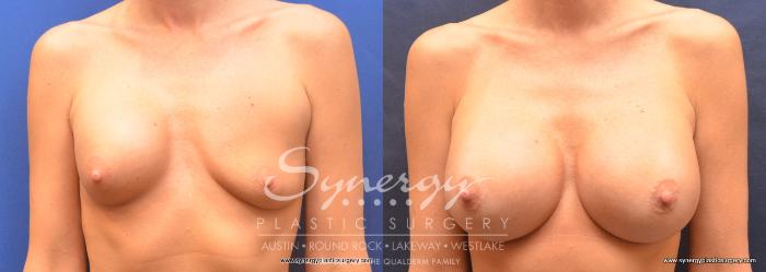 Before & After Revision Breast Augmentation Case 758 View #1 View in Austin, TX