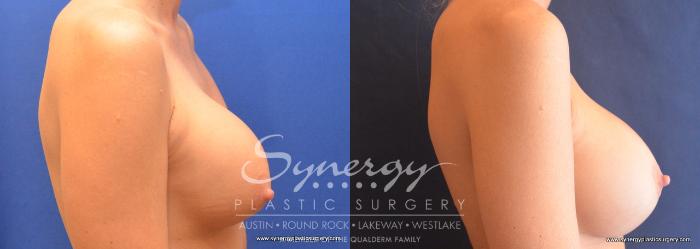 Before & After Revision Breast Augmentation Case 758 View #5 View in Austin, TX