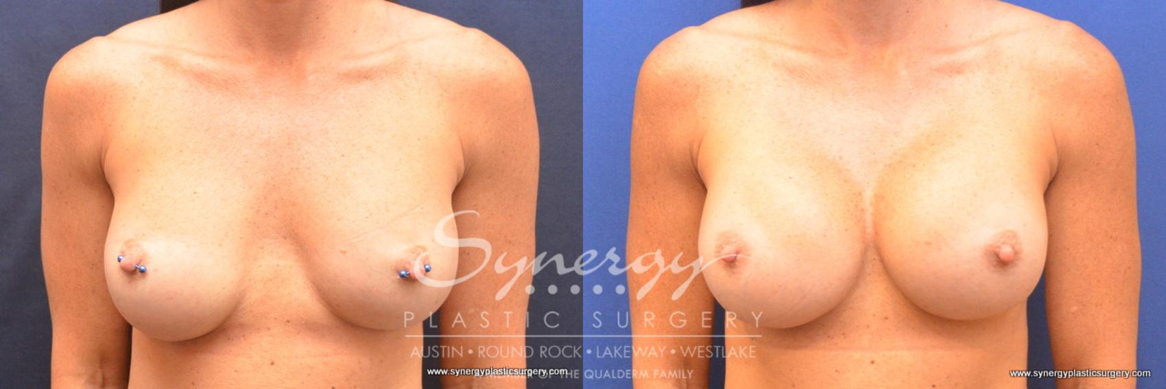 Before & After Revision Breast Augmentation Case 761 View #1 View in Austin, TX