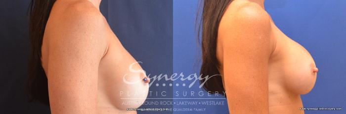 Before & After Revision Breast Augmentation Case 761 View #2 View in Austin, TX