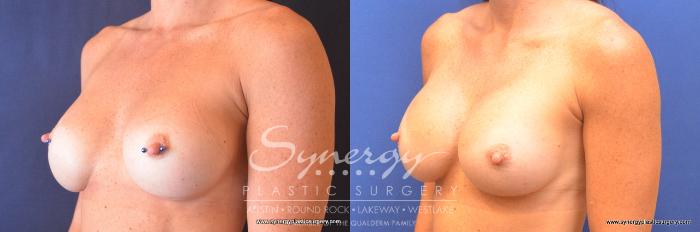 Before & After Revision Breast Augmentation Case 761 View #4 View in Austin, TX
