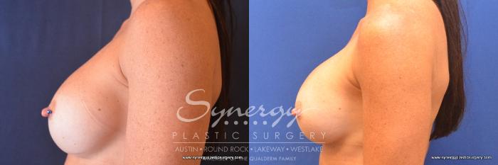 Before & After Revision Breast Augmentation Case 761 View #5 View in Austin, TX