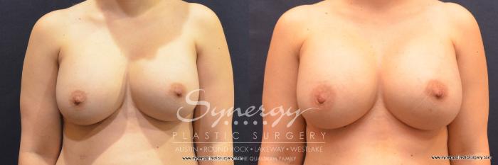 Before & After Revision Breast Augmentation Case 788 View #1 View in Austin, TX