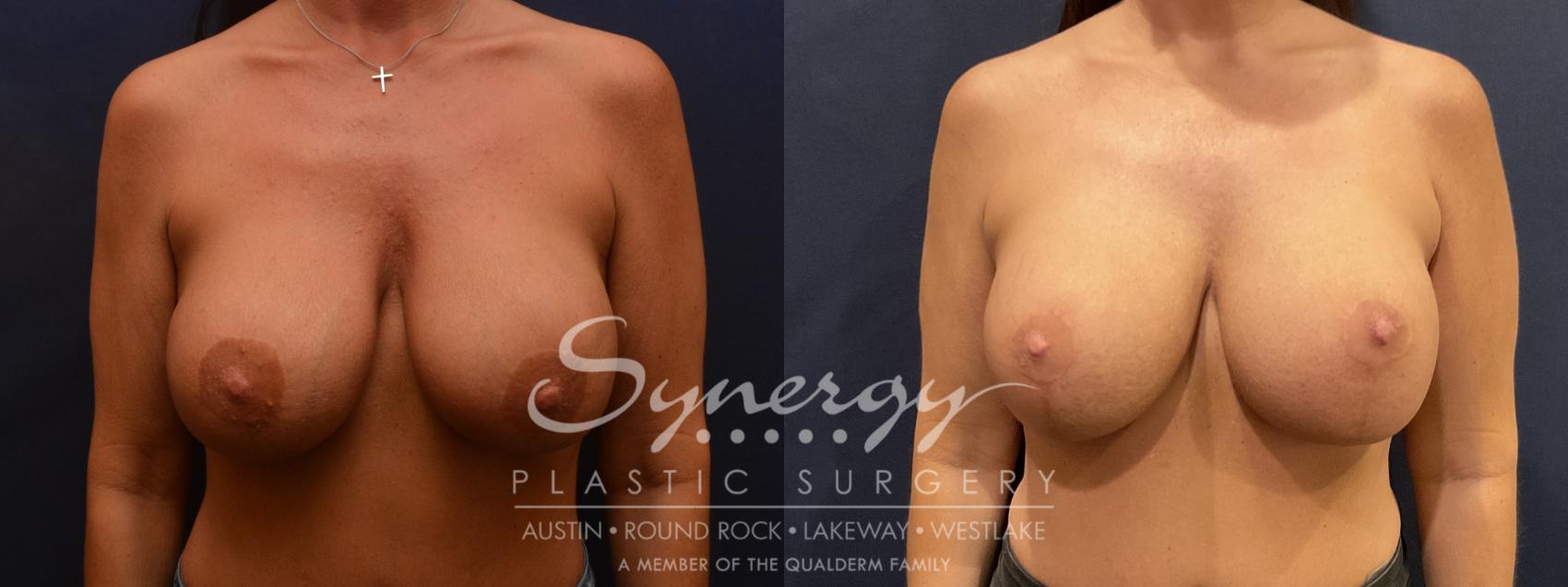 Implant exchange, Synergy plastic surgery