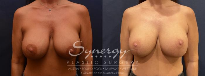 Implant exchange, Synergy plastic surgery