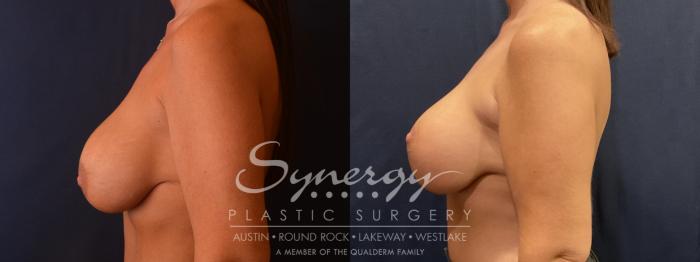 Implant exchange, Synergy plastic surgery