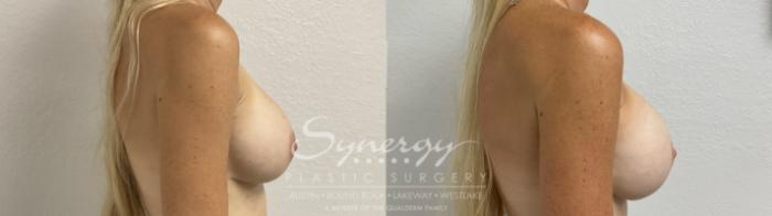 Before & After Revision Breast Augmentation Case 860 Left Side View in Austin, TX