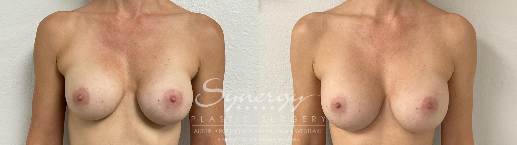 Before & After Revision Breast Augmentation Case 885 Front View in Austin, TX