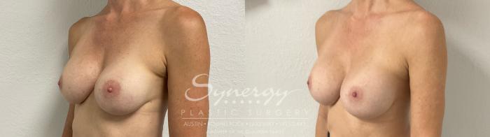Before & After Revision Breast Augmentation Case 885 Right Oblique View in Austin, TX