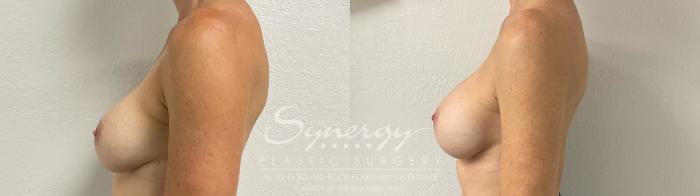 Before & After Revision Breast Augmentation Case 885 Right Side View in Austin, TX