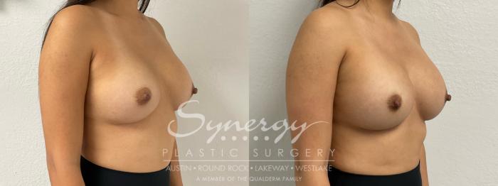 Before & After  Case 891 Right Oblique View in Austin, TX