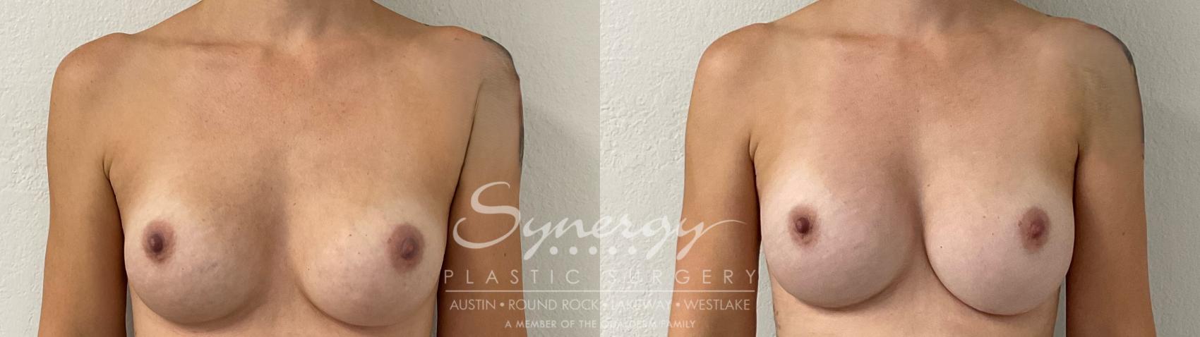 Before & After Revision Breast Augmentation Case 914 Front View in Austin, TX
