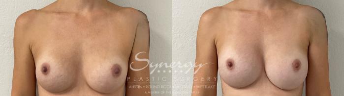 Before & After Revision Breast Augmentation Case 914 Front View in Austin, TX