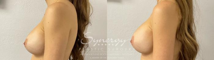 Before & After Revision Breast Augmentation Case 924 Left Side View in Austin, TX