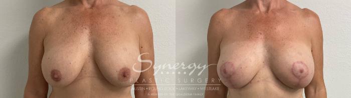 Before & After Revision Breast Augmentation Case 925 Front View in Austin, TX