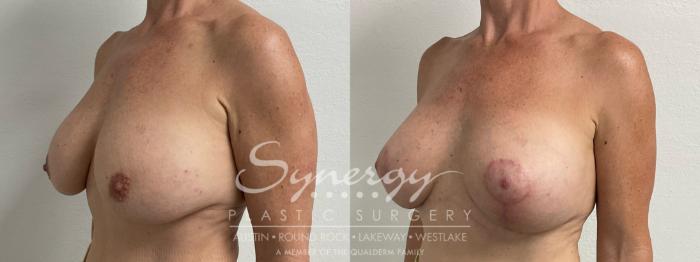 Before & After Revision Breast Augmentation Case 925 Left Oblique View in Austin, TX