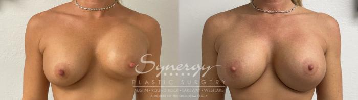 Before & After Revision Breast Augmentation Case 926 Front View in Austin, TX
