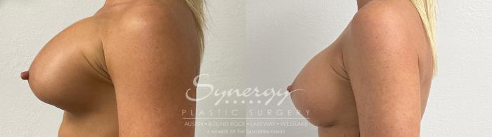 Before & After Revision Breast Augmentation Case 926 Left Side View in Austin, TX