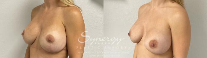 Before & After Revision Breast Augmentation Case 944 Left Oblique View in Austin, TX