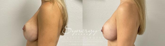 Before & After Revision Breast Augmentation Case 944 Left Side View in Austin, TX