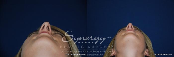 Before & After  Case 200 View #5 View in Austin, TX