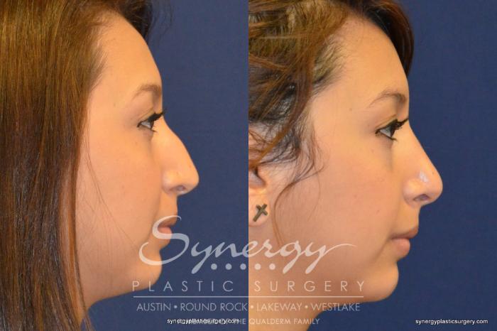 Before & After Rhinoplasty Case 201 View #1 View in Austin, TX