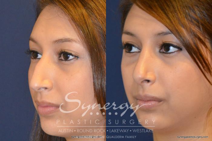 Before & After  Case 201 View #5 View in Austin, TX